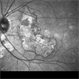 Macula Serpiginous Choroidopathy Macula Serpiginous Choroidopathy